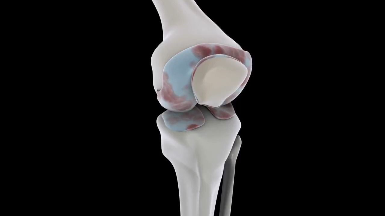 Terrebonne General To Your Health: Total Knee Replacement