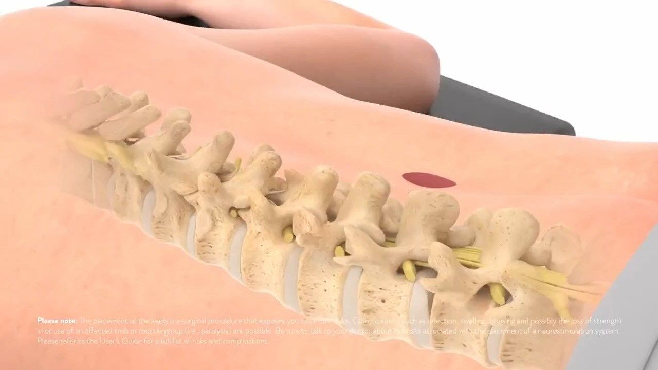 Terrebonne General To Your Health: Spinal Cord Stimulator Placement