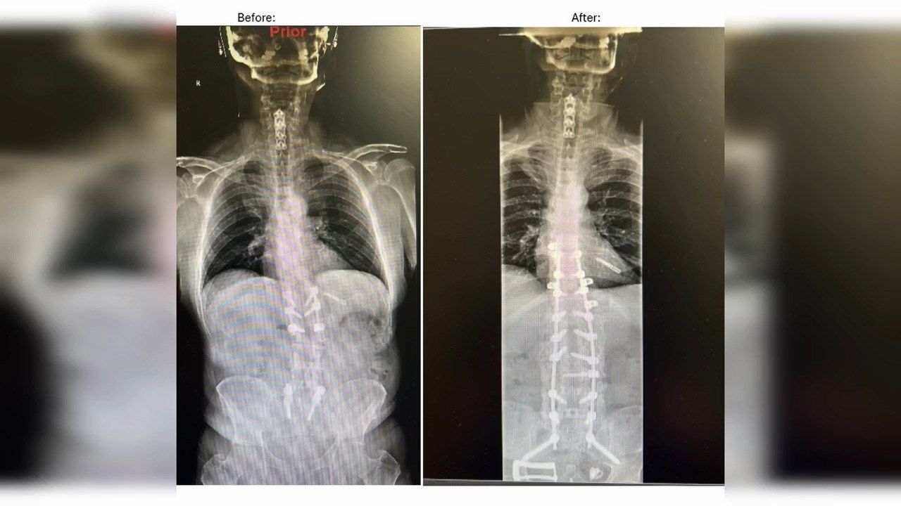 Terrebonne General To Your Health: Surgical Treatment for Scoliosis